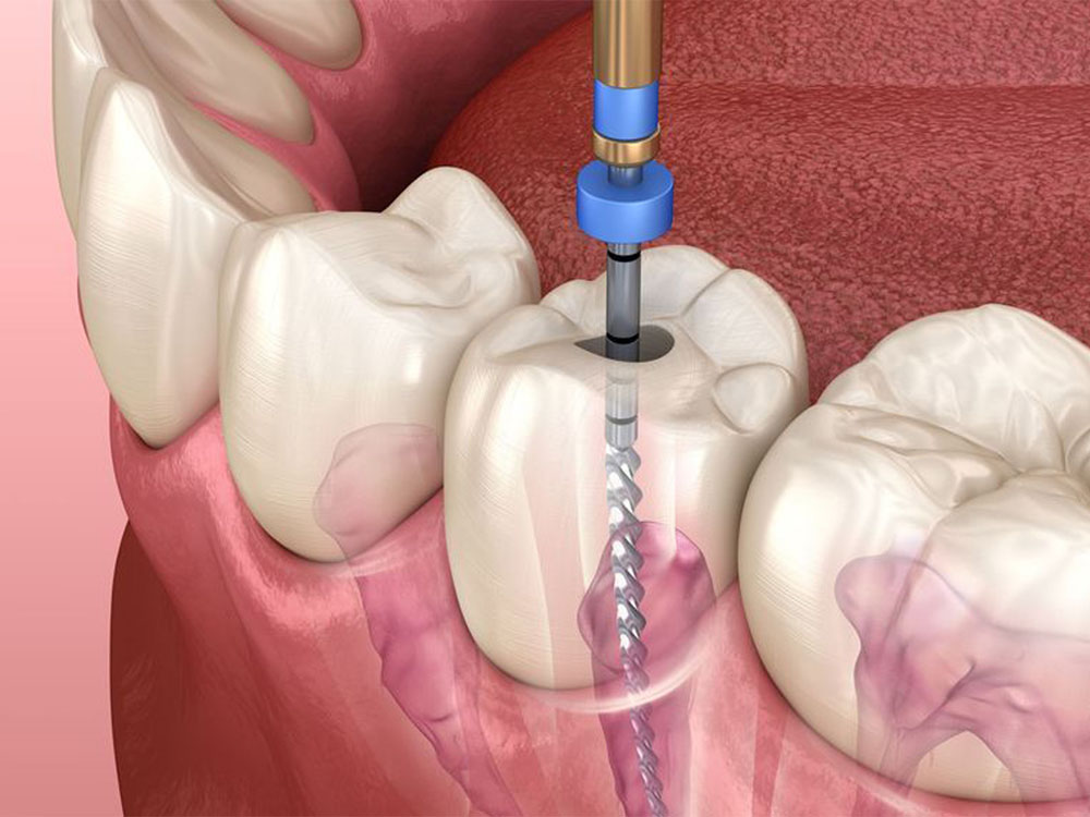 Endodonti ( Kanal Tedavi ) & Diş Çürükleri